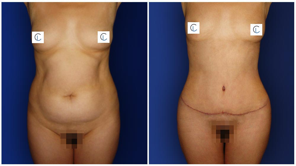 0-march-tummytuck-4